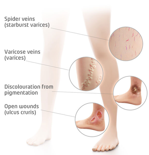 Venous Insufficiency  Healing the Generations